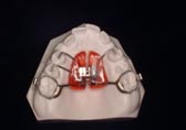 Palatal Expander